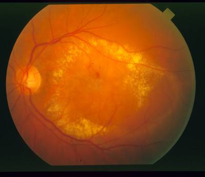 Sample image from STARE