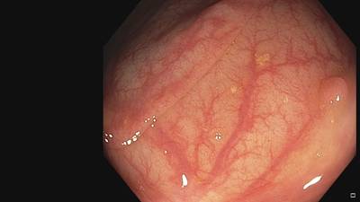 Sample image from Fine Grained Polyp