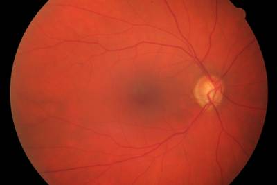 Sample image from High Resolution Fundus