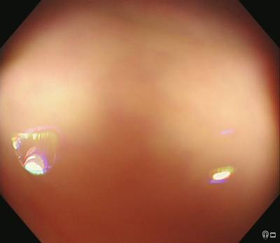 Sample image from PolypGen