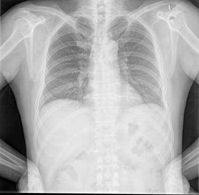 Sample image from Chest Xray Masks and Labels