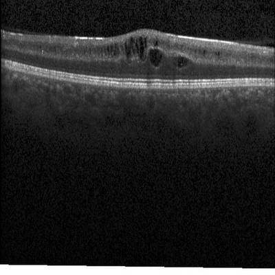 Sample image from Intraretinal Cystoid Fluid