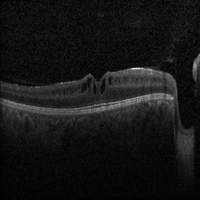 Sample image from Intraretinal Cystoid Fluid