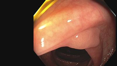 Sample image from Fine Grained Polyp
