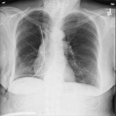 Sample image from SIIM-ACR Pneumothorax Segmentation 2019