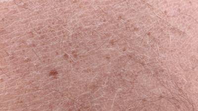 Sample image from Accurate Nevus Shapes