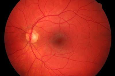 Sample image from High Resolution Fundus