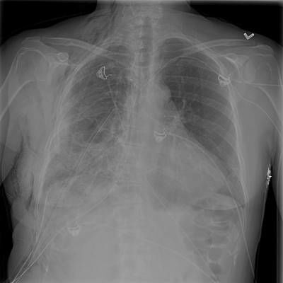 Sample image from SIIM-ACR Pneumothorax Segmentation 2019