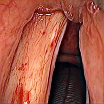 Sample image from Laryngeal Endoscopic