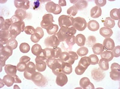 Sample image from Plasmodium Falciparum from Images of Giemsa for Malaria Detection