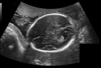 Sample image from Fetal Head UltraSound