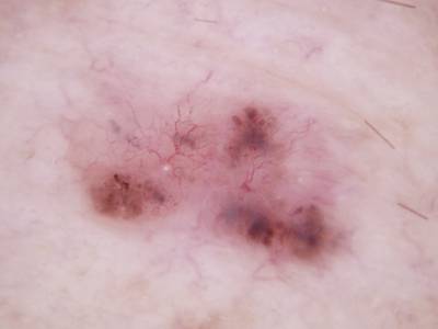 Sample image from Skin Cancer: HAM10000