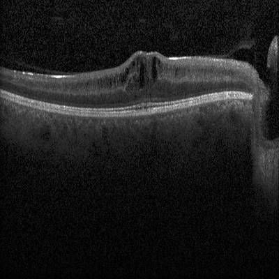 Sample image from Intraretinal Cystoid Fluid