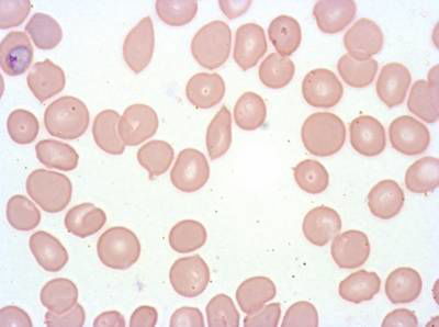 Sample image from Plasmodium Falciparum from Images of Giemsa for Malaria Detection