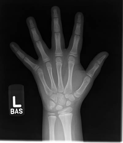 Sample image from RSNA Bone Age 2017