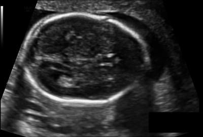 Sample image from Fetal Head UltraSound