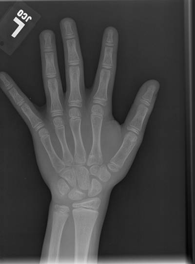 Sample image from RSNA Bone Age 2017