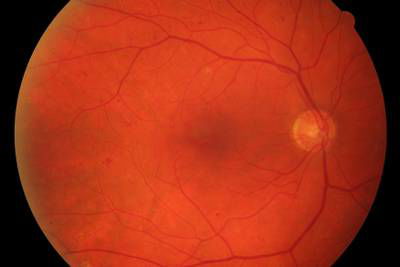 Sample image from High Resolution Fundus