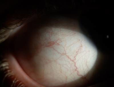 Sample image from Eyes Microcirculation