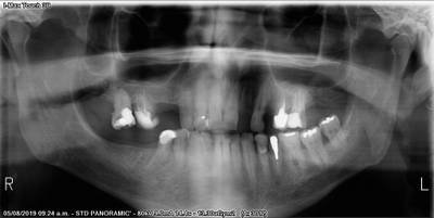 Sample image from Teeth Segmentation on Dental X-ray Images