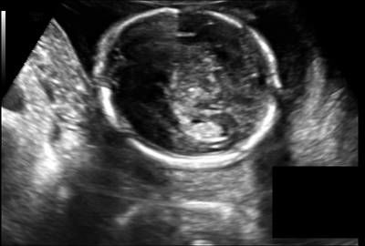 Sample image from Fetal Head UltraSound