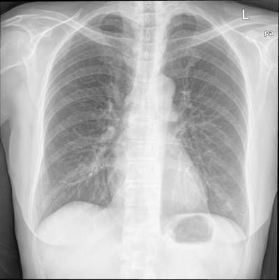 Sample image from Chest Xray Masks and Labels