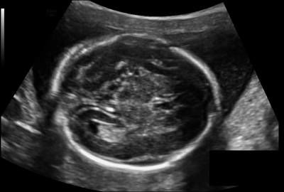 Sample image from Fetal Head UltraSound