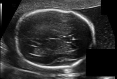 Sample image from Fetal Head UltraSound
