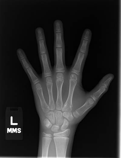 Sample image from RSNA Bone Age 2017