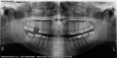 Sample image from Teeth Segmentation on Dental X-ray Images