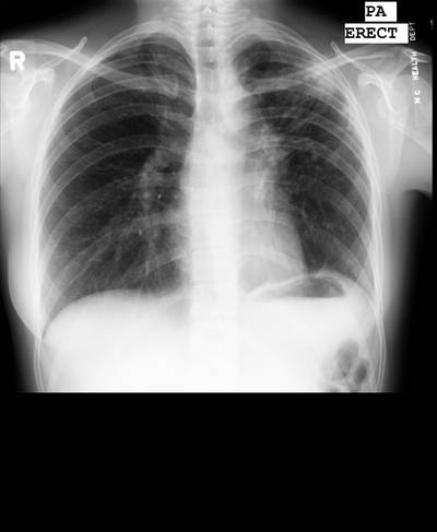 Sample image from Chest Xray Masks and Labels