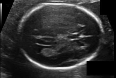 Sample image from Fetal Head UltraSound