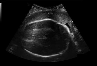 Sample image from Fetal Head UltraSound