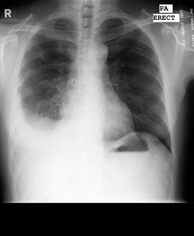 Sample image from Chest Xray Masks and Labels