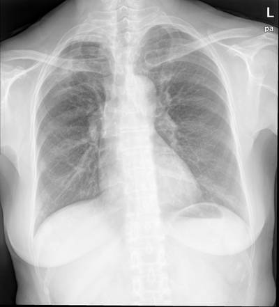 Sample image from Chest Xray Masks and Labels