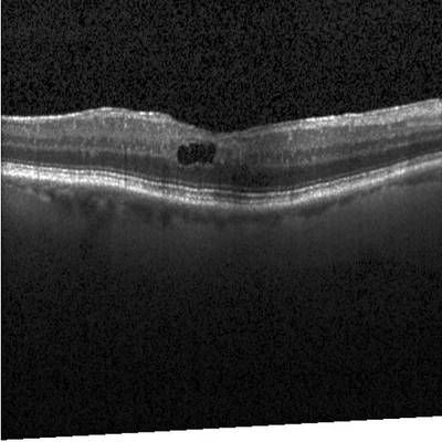 Sample image from Intraretinal Cystoid Fluid