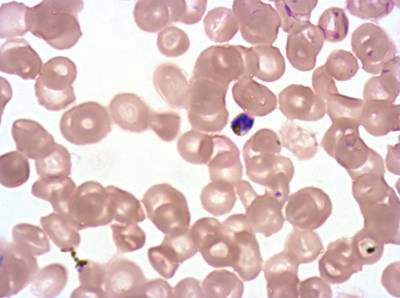 Sample image from Plasmodium Falciparum from Images of Giemsa for Malaria Detection