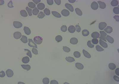 Sample image from P. Vivax (Malaria) Infected Human Blood Smears