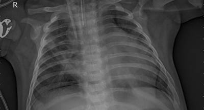 Sample image from ZhangLabData: Chest X-Ray