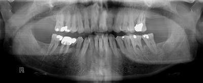 Sample image from Panoramic Dental X-rays