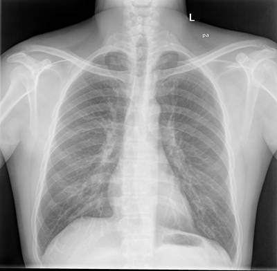 Sample image from Chest Xray Masks and Labels