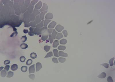 Sample image from P. Vivax (Malaria) Infected Human Blood Smears