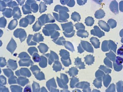 Sample image from Plasmodium Falciparum from Images of Giemsa for Malaria Detection