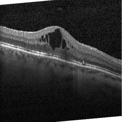 Sample image from Intraretinal Cystoid Fluid