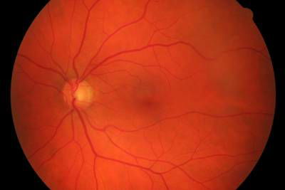 Sample image from High Resolution Fundus