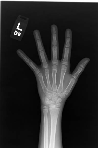 Sample image from RSNA Bone Age 2017