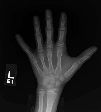 Sample image from RSNA Bone Age 2017