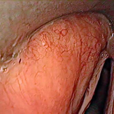 Sample image from Laryngeal Endoscopic