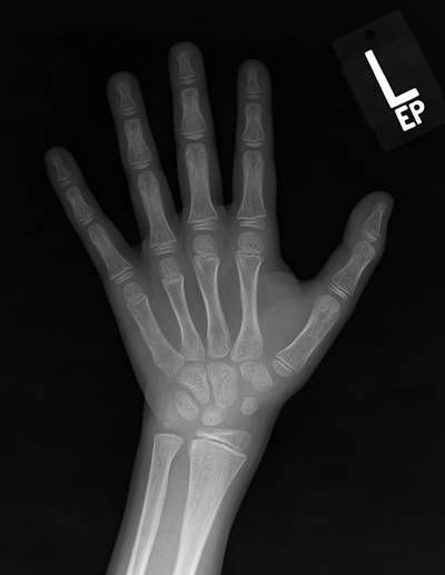 Sample image from RSNA Bone Age 2017