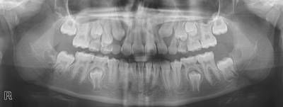 Sample image from Panoramic Dental X-rays